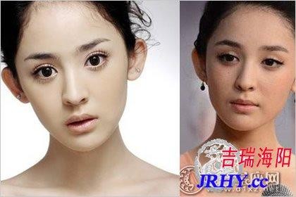 有招风耳的女人就会失财吗 招风耳矫正