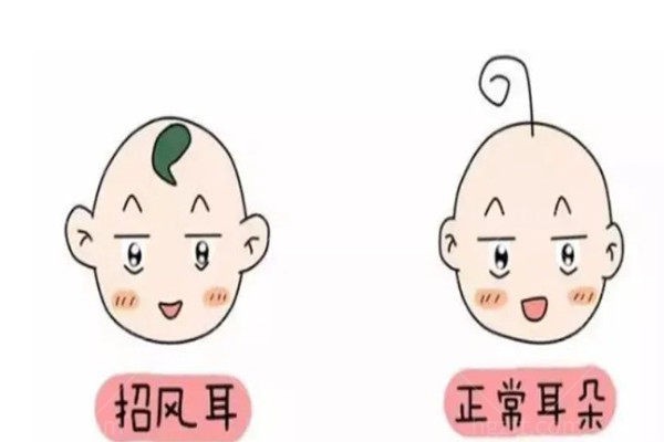 成人招风耳可以矫正吗