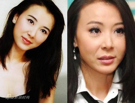 女星整容失败变“丑星” 揭3大热门整容项目后遗症