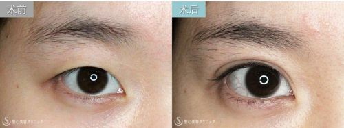 日式整形医生解析：如何拥有日本女明星般的日式精致脸？