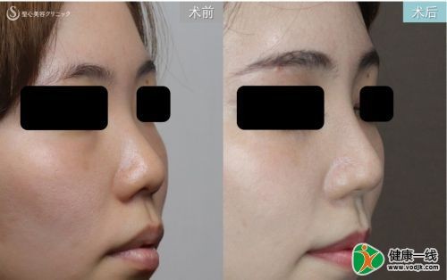 日式整形医生解析：如何拥有日本女明星般的日式精致脸？