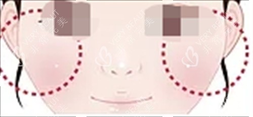 玻尿酸填充眼下填充