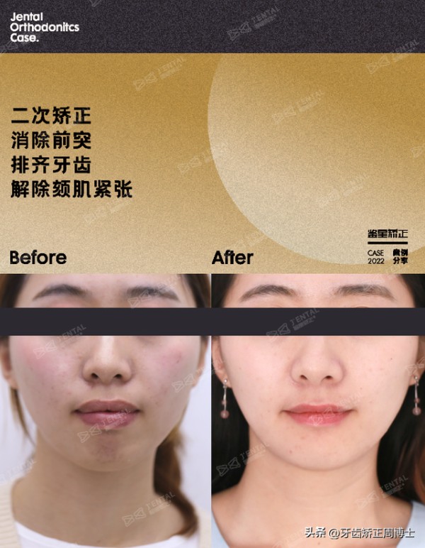 二次矫正8颗骨钉改变面型！矫正后竟“撞脸”明星