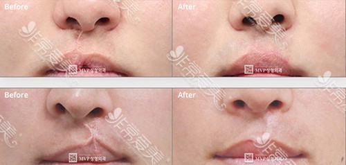 唇腭裂手术对比日记