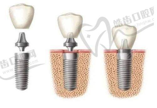 河源红星路红星口腔门诊部种植牙最低2980元包烤瓷牙，现场抽零元种植有成交伴手礼仕诺康等植体活动价