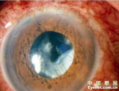 佛山儿童眼科哪里最好?公布佛山儿童眼科排名第一医院及看小孩眼科专业的优质医院!