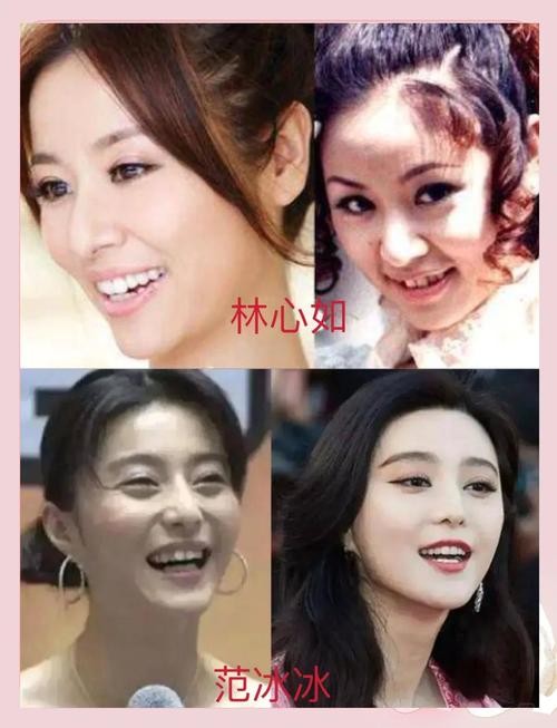 为何成年明星纷纷选择矫正牙齿?年龄是影响因素吗?-图1