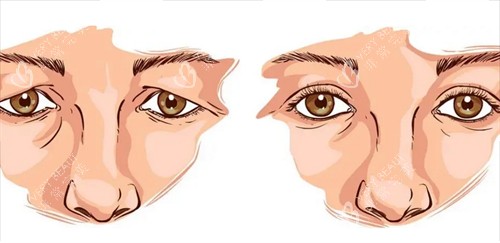 双眼皮修复前后