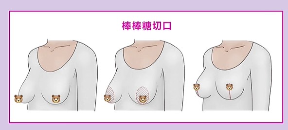 武汉包涛脂肪胸存活高吗？答案在这里！90%做过的人说存活率符合预期