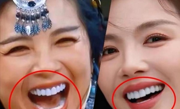 一口假牙，三百万花费，终身饮食限制，明星光鲜背后的真实代价