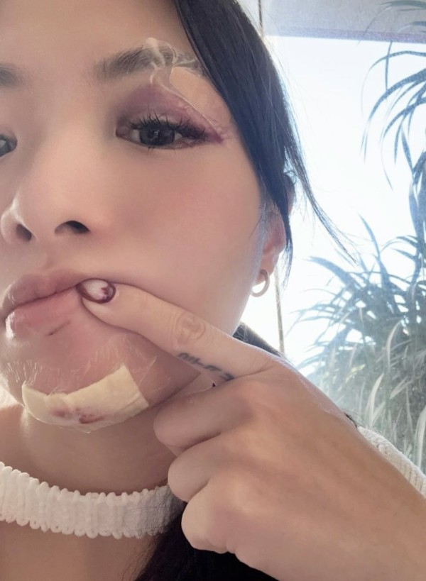 香港女星下楼梯摔倒导致面部骨折，眼部瘀青照吓坏网友