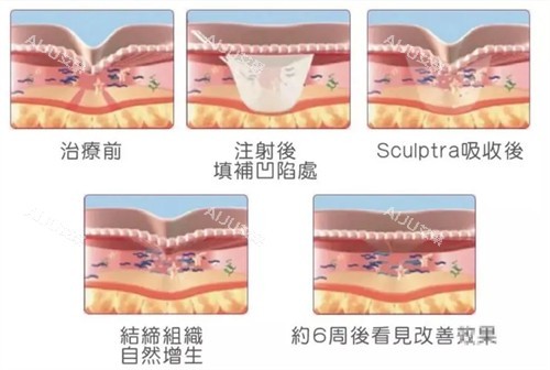注射童颜针后皮肤的变化周期