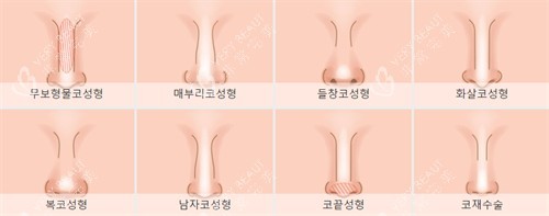 不同需要进行鼻整形的鼻子