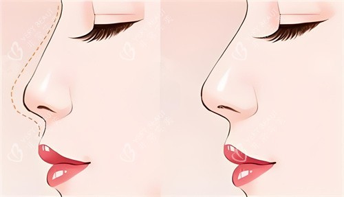 隆鼻前后对比动画图