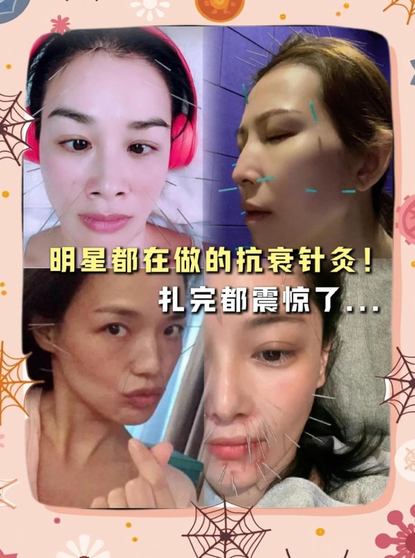 女星不老秘诀针灸抗衰逆龄✨