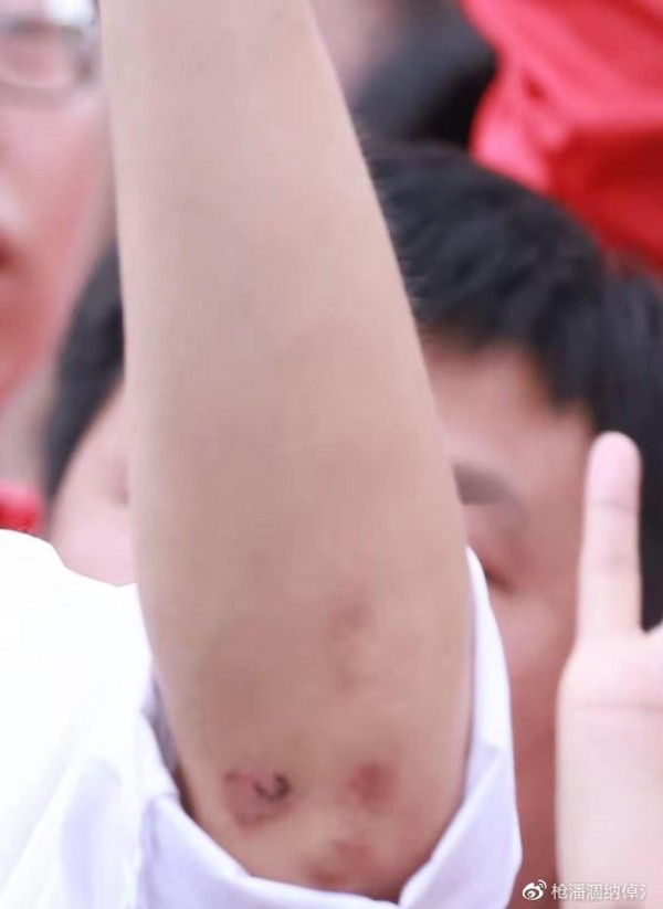 张哲瀚手臂被粉丝抓伤，网友发声称，请理智追星