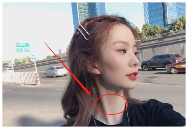 陈卓璇无美颜无滤镜下原来长这样，有谁注意她的脖子？原来是胎记