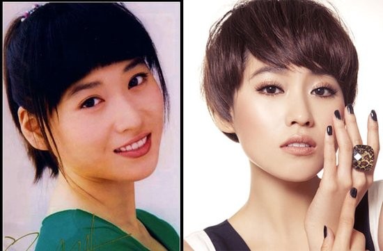 宁丹琳整形手术前后对比照