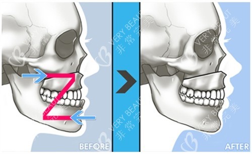 韩国双鄂轮廓胸整形怎么选?原辰整形外科综合塑型实力,明星同款脸必看!