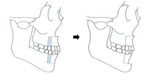 双鄂手术过程演示动画图