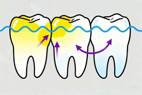 牙齿美白变化图