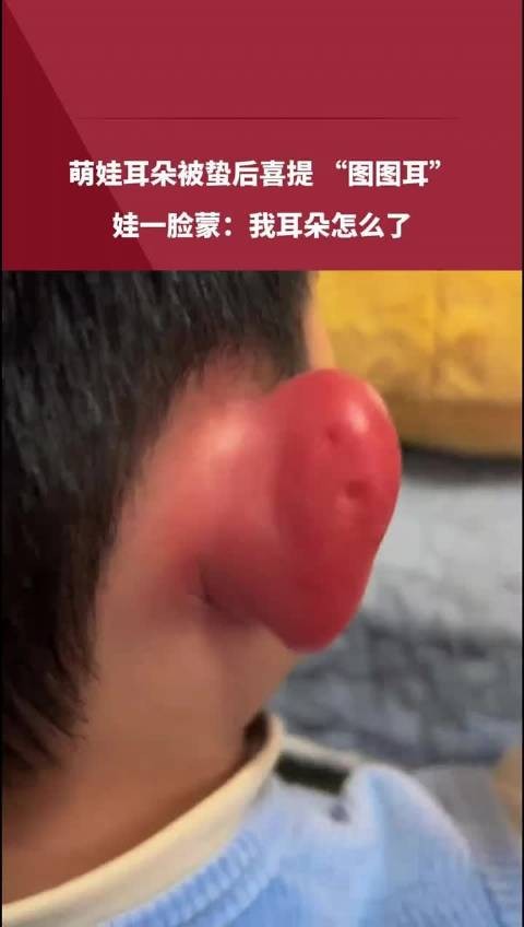 萌娃耳朵被蛰后喜提 “图图耳”，娃一脸蒙：我耳朵怎么了