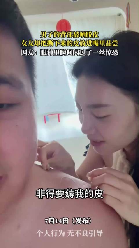 男子的背部被晒脱皮，女友却把撕下来的皮放进嘴里品尝…